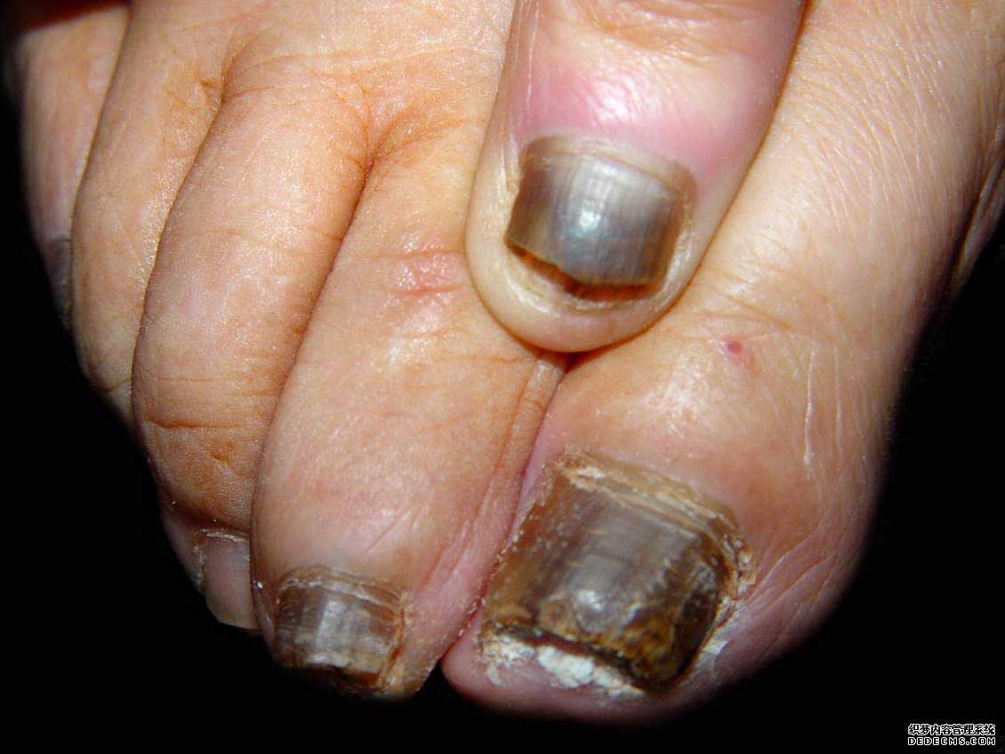 灰指甲治疗成功案例四