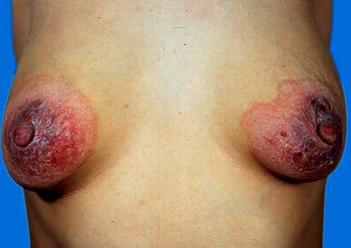 乳房湿疹的防护措施有哪些