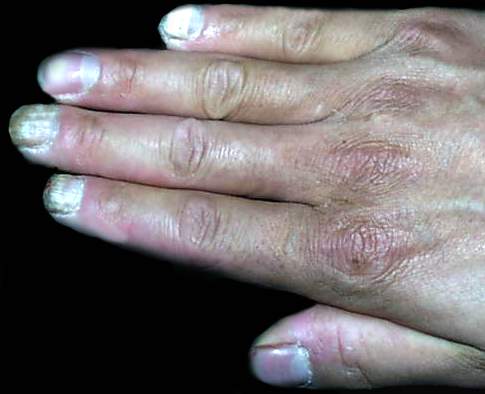 灰指甲治疗成功案例三