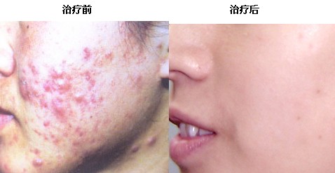 痤疮治疗前后对比图