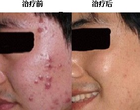 帅哥痤疮治疗成功