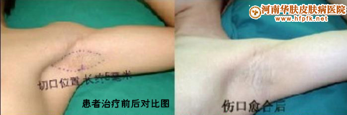 腋臭该怎么治疗