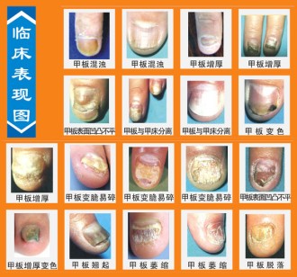 灰指甲图片
