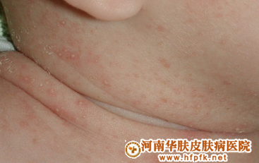 痱子和湿疹的区别