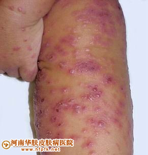 痱子和湿疹的区别