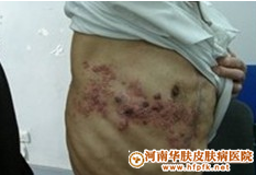 病毒性疱疹的治疗方法_郑州治疗带状疱疹较好的医院