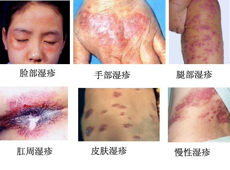 不同部位的湿疹