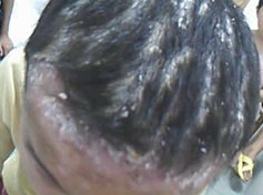 头部牛皮癣
